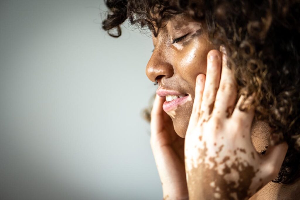 Portrait of young Brazilian woman with Vitiligo on face and hands, close up of details of mouth, closed eyes and curly hair, white background